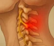 Radiculopatia Cervical: Compressão de Raízes Nervosas