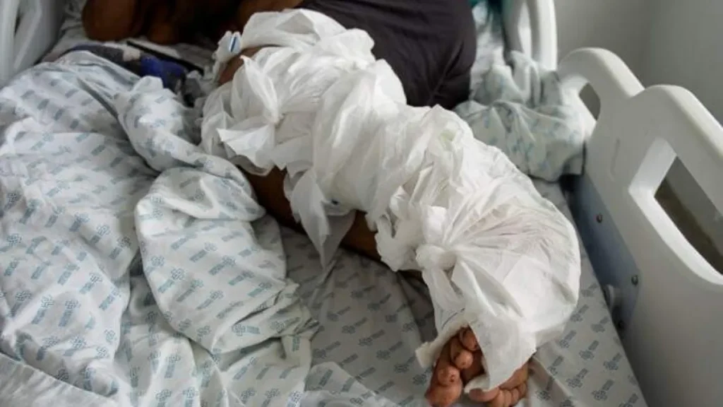 Brazil seeks public input on orthopedic surgery backlog